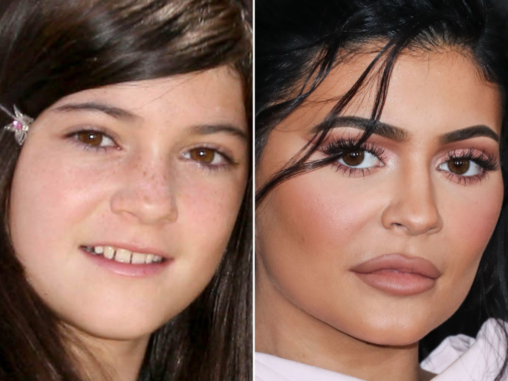 When Kylie Jenner Revealed Her Regret Of Having Surgery At 19 Wish I Had Never Masala